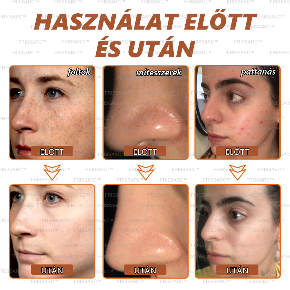 ✨🌙FRISSARC™ fehérítő és folteltávolító arcmaszk –👩⚕️Természetes összetevők tartósan eltüntetik a foltokat, szeplőket és napfoltokat.
