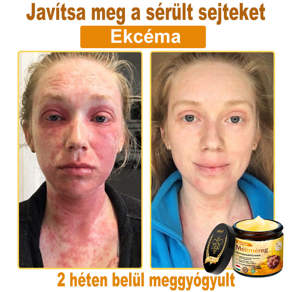 🐝👨⚕ ZödVita® Méhméreg Bőr Helyreállító Krém (👨⚕CE jóváhagyott)👍✅