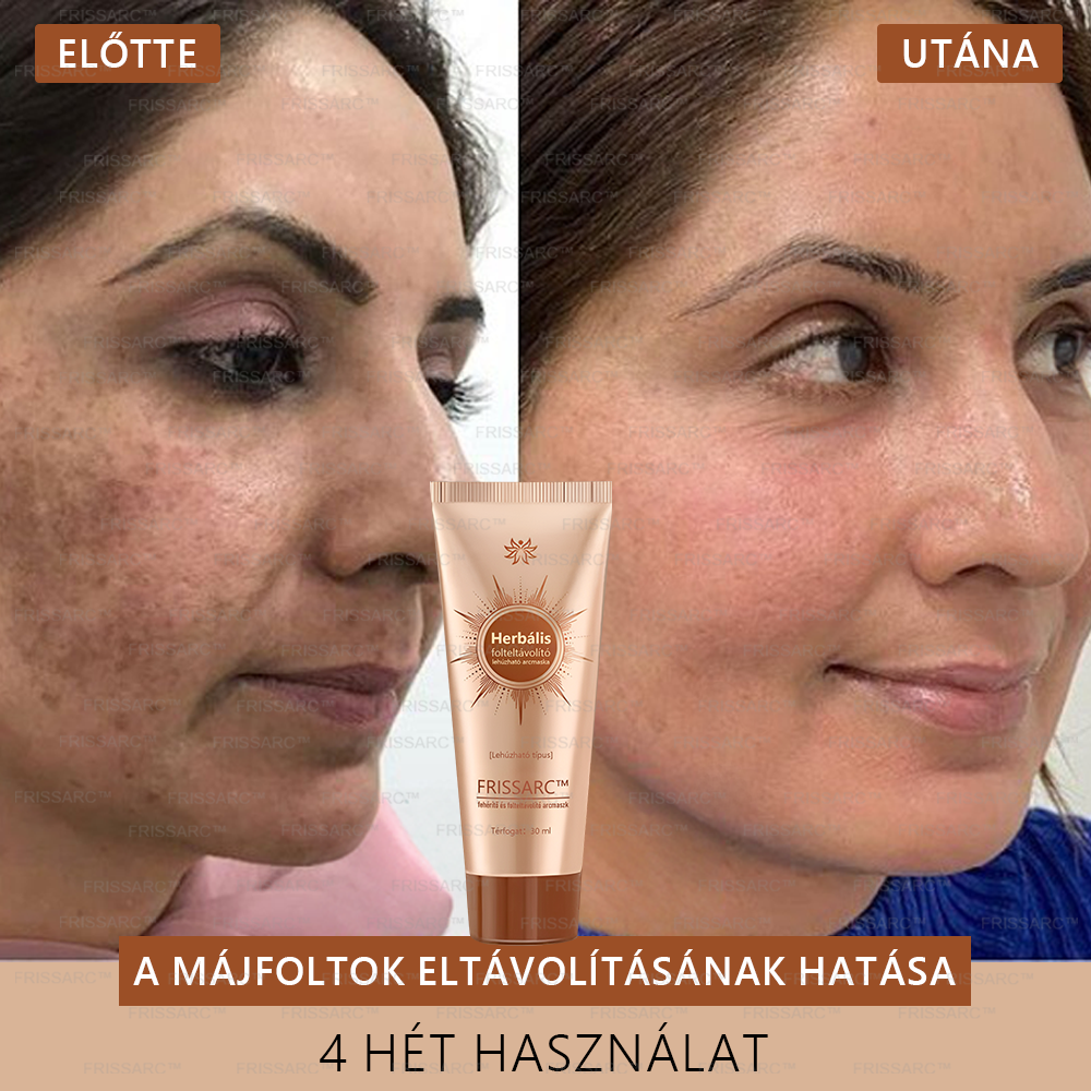 ✨🌙FRISSARC™ fehérítő és folteltávolító arcmaszk –👩⚕️Természetes összetevők tartósan eltüntetik a foltokat, szeplőket és napfoltokat.