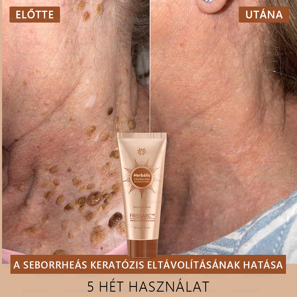 ✨🌙FRISSARC™ fehérítő és folteltávolító arcmaszk –👩⚕️Természetes összetevők tartósan eltüntetik a foltokat, szeplőket és napfoltokat.