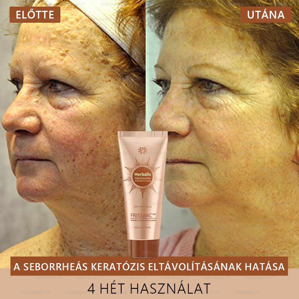 ✨🌙FRISSARC™ fehérítő és folteltávolító arcmaszk –👩⚕️Természetes összetevők tartósan eltüntetik a foltokat, szeplőket és napfoltokat.