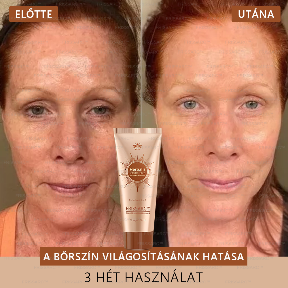 ✨🌙FRISSARC™ fehérítő és folteltávolító arcmaszk –👩⚕️Természetes összetevők tartósan eltüntetik a foltokat, szeplőket és napfoltokat.