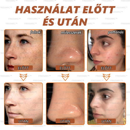 🌙 FRISSARC™ fehérítő és folteltávolító arcmaszk –👩‍⚕️Természetes összetevők tartósan eltüntetik a foltokat, szeplőket és napfoltokat.